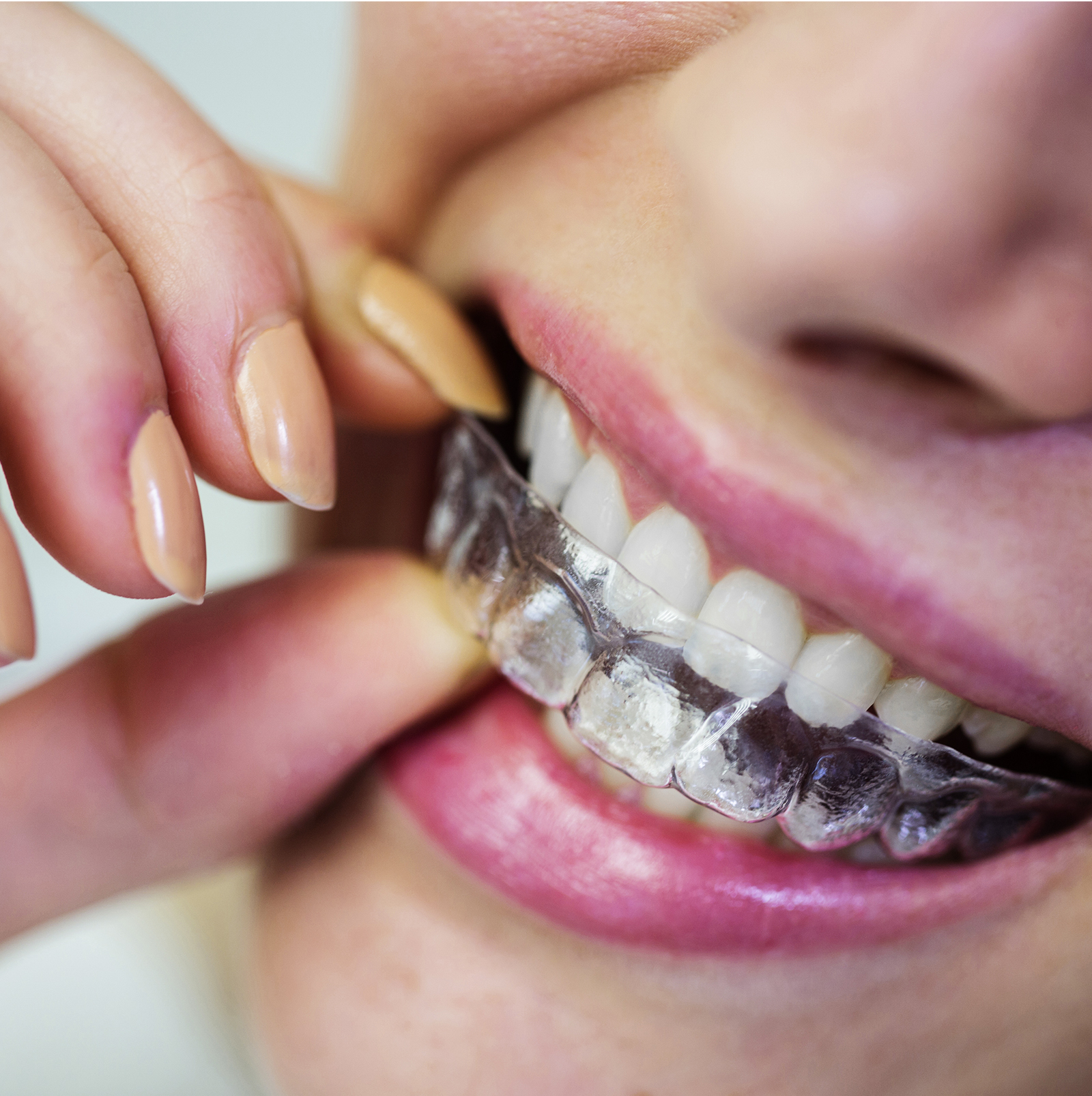 Invisalign Treatment