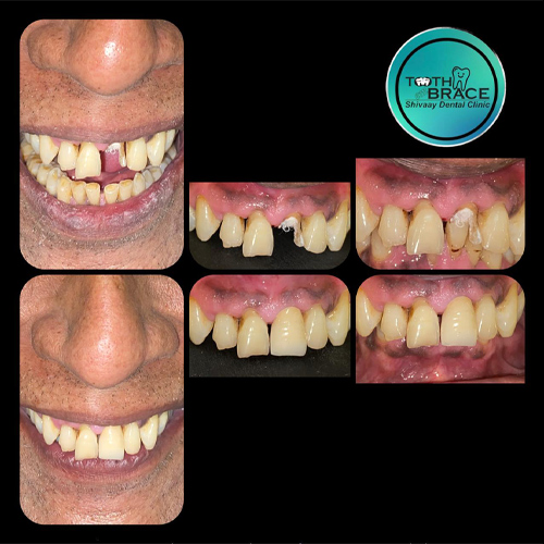 Treatement Before & After image