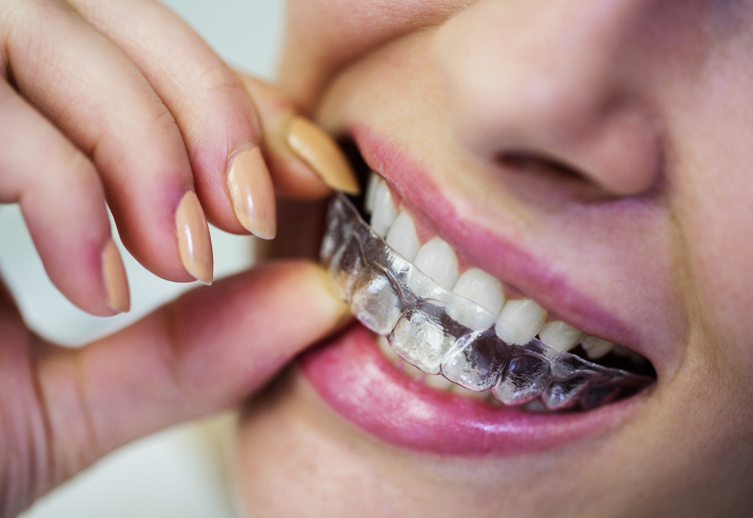 Invisalign Treatment